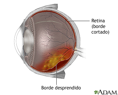 Separación anormal entre dos de las capas que constituyen la retina