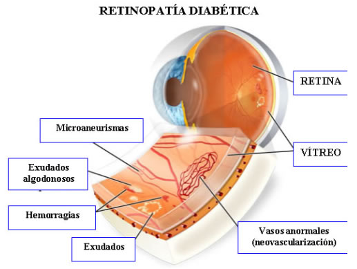 Imagen Retinopatía diabética
